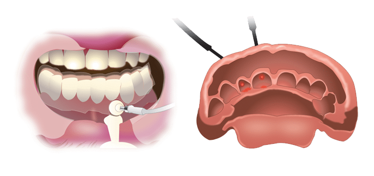 Misurazione del Cavo Orale